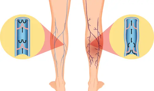 Spataderen voorkomen met compressiekousen